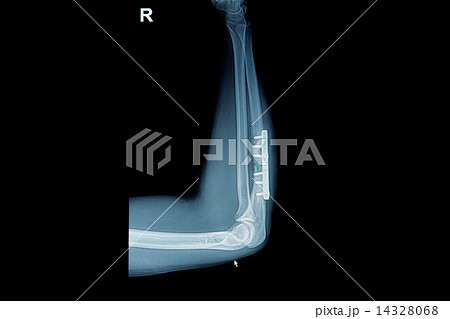 Film x-ray wrist fracture Film x-ray wrist fracture 14328068
