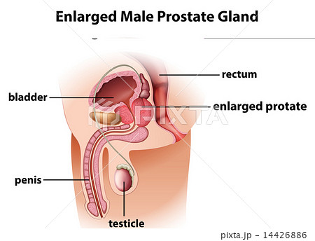 Enlarged male prostate gland 14426886