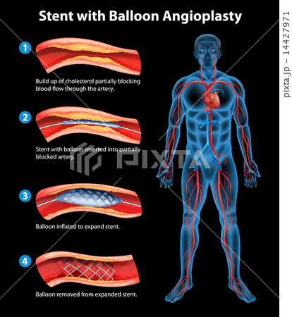 Stent angioplasty procedure Stent angioplasty procedure 14427971