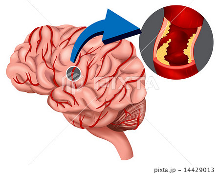 Blood Clot concept in the brain Blood Clot concept in the brain 14429013