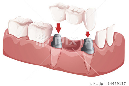 Dental bridge Dental bridge 14429157