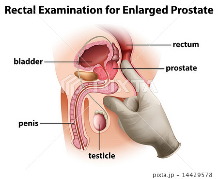 Rectal Examination for Enlarged Prostate 14429578