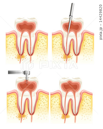 Dental root canal 14429820