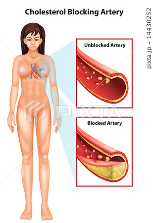 Ateriosclerosis 14430252