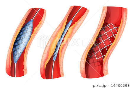 Stent used to open blocked artery Stent used to open blocked artery 14430293