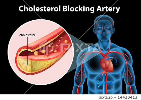 Ateriosclerosis 14430413