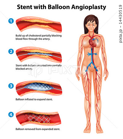 Stent angioplasty procedure Stent angioplasty procedure 14430519