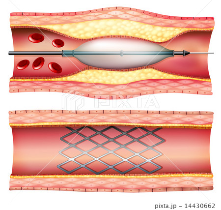 Stent Angioplasty Stent Angioplasty 14430662