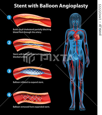 Stent angioplasty procedure Stent angioplasty procedure 14435555