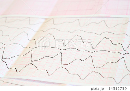 ECG tape with paroxysmal ventricular tachycardia 14512759