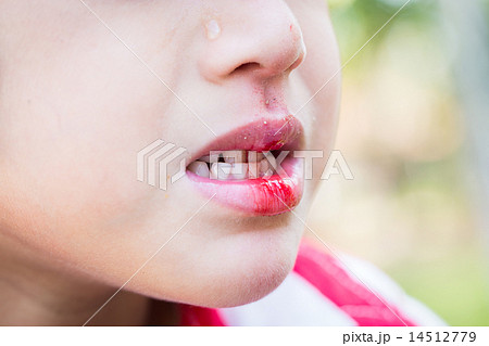 Little boy Bleeding at the mouth Little boy Bleeding at the mouth 14512779