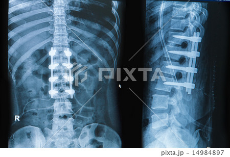 spinal column with implant fusion 14984897