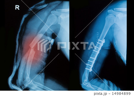 x-ray image of borken arm bone  14984899