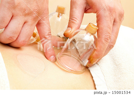 カッピングセラピー アジア Cupping therapy Asia カッピングセラピー アジア Cupping therapy Asia 15001534