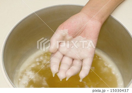 Hand in paraffin bath 15030437