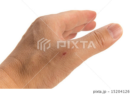 すり傷 すり傷 15204126