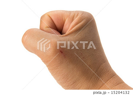 すり傷 すり傷 15204132