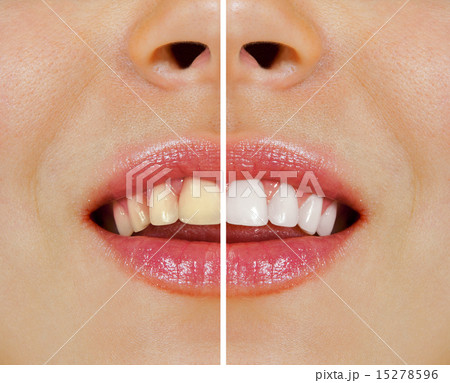 teeth before and after whitening teeth before and after whitening 15278596