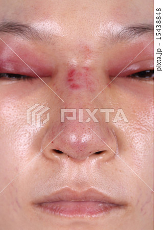 nose and eye swelll after nose job 15438848