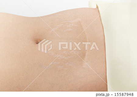 女性の帝王切開による手術痕 15587948