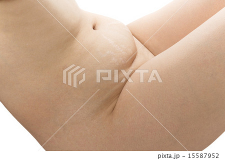 手術痕 手術痕 15587952