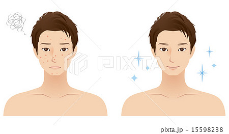 男性 顔 肌トラブル ニキビのイラスト素材