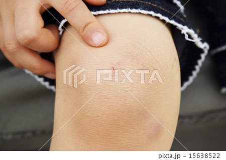 子どもの怪我 15638522