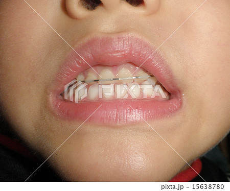 乳歯の矯正 乳歯の矯正 15638780