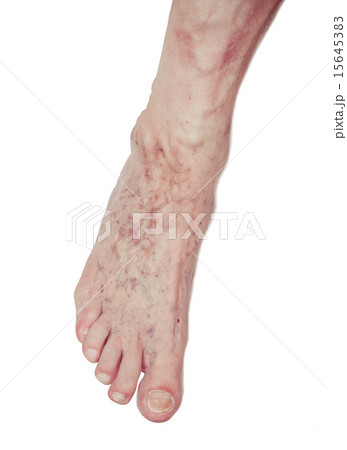 Varicose Veins on the leg Varicose Veins on the leg 15645383