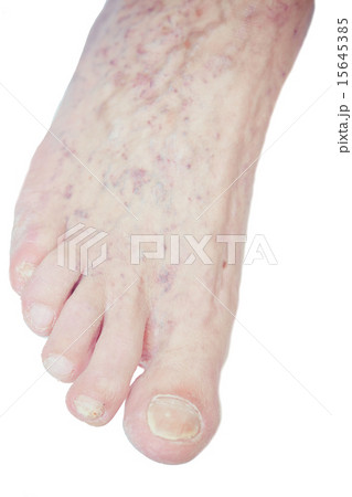 Varicose Veins on the leg Varicose Veins on the leg 15645385