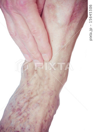 Varicose Veins on the leg 15645386