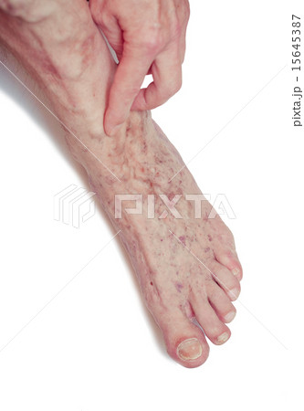 Varicose Veins on the leg Varicose Veins on the leg 15645387