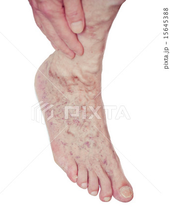 Varicose Veins on the leg Varicose Veins on the leg 15645388