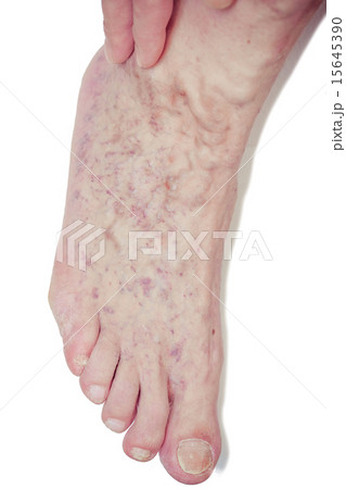 Varicose Veins on the leg 15645390