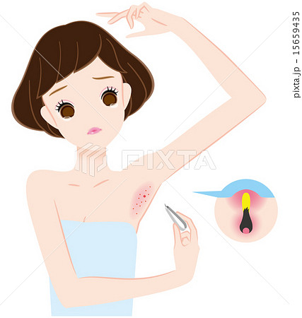 毛抜きで腋毛自己処理して炎症 化膿のイラスト素材