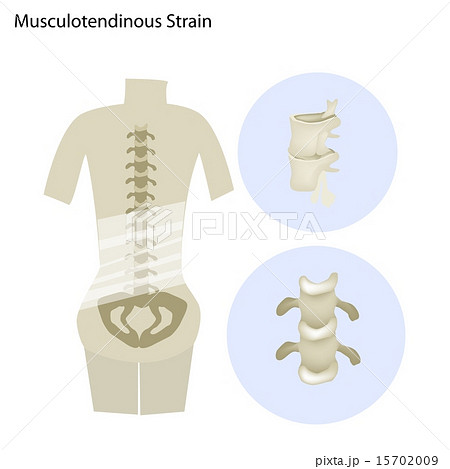 Illustration of Musculotendinous Strain Illustration of Musculotendinous Strain 15702009