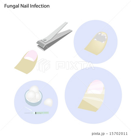 Fungal Nail Infection and Take Care 15702011