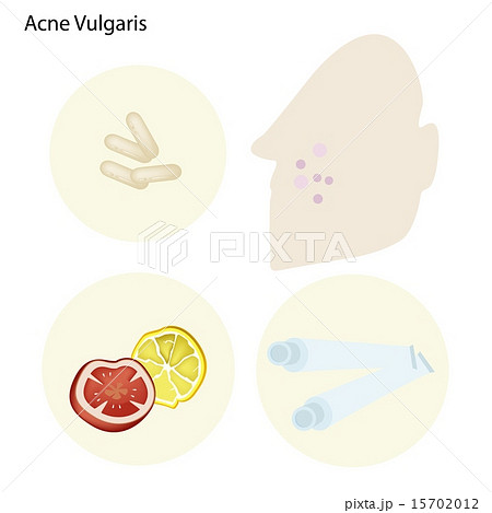 Acne Vulgaris and Take Care Facial Skin Acne Vulgaris and Take Care Facial Skin 15702012