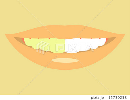 黄ばんだ歯 白い歯 比較のイラスト素材
