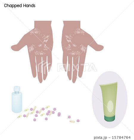 Cracked Hands with Prevention and Spa Treatment Cracked Hands with Prevention and Spa Treatment 15784764