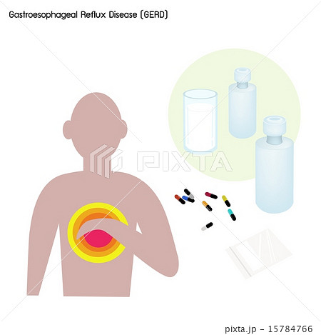 Gastroesophageal Reflux Disease or GERD Gastroesophageal Reflux Disease or GERD 15784766