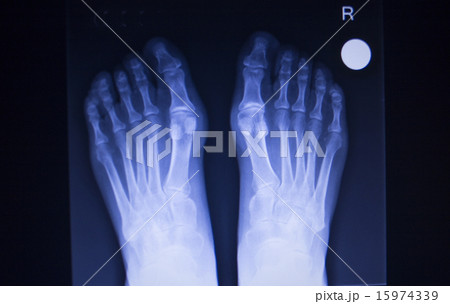 X-ray scan of foot injury anterior posterior AP X-ray scan of foot injury anterior posterior AP 15974339