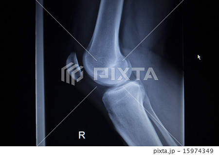 X-ray scan of painful knee meniscus leg injury 15974349
