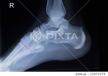 X-ray orthopedics scan of foot injury X-ray orthopedics scan of foot injury 15974374