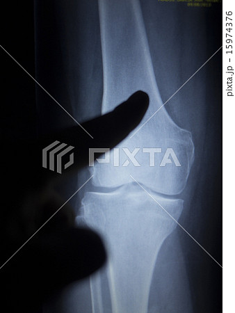 X-ray scan of painful knee meniscus leg injury X-ray scan of painful knee meniscus leg injury 15974376