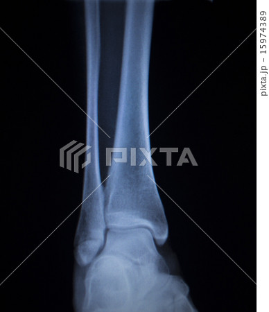 X-ray scan of painful ankle foot injury 15974389