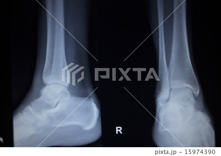 X-ray orthopedics scan painful ankle foot injury 15974390