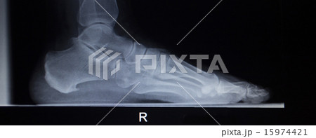 X-ray scan of foot injury load weight bearing 15974421