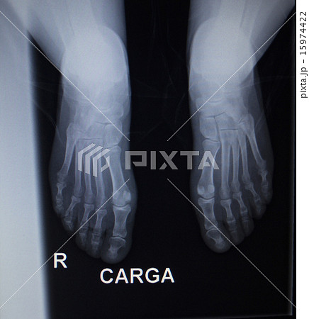 X-ray scan of foot injury anterior posterior AP 15974422
