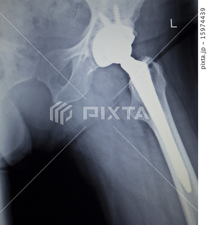 X-ray scan  image of hip joint orthopedic implant 15974439